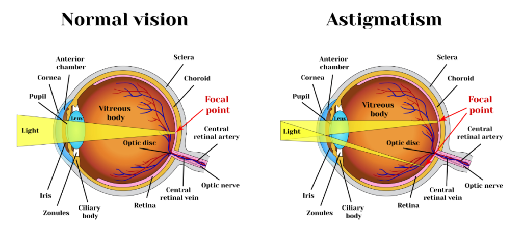 restaurează viziunea cu astigmatism